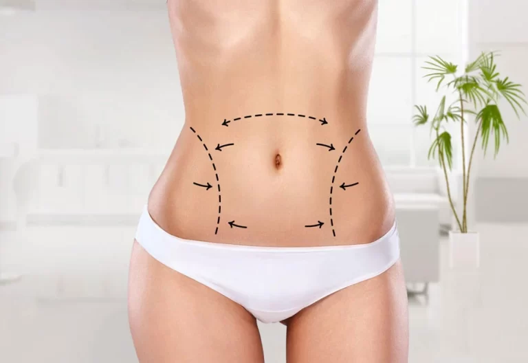 Liposuccion douce