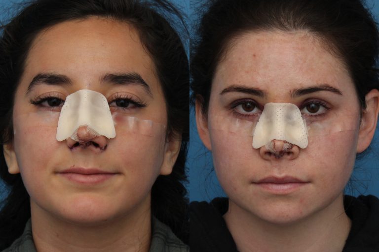 Rhinoplastie post-opératoire