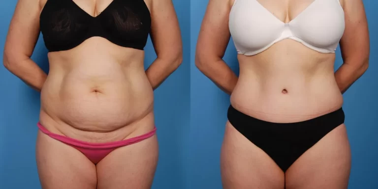 abdominoplastie jour apres jour