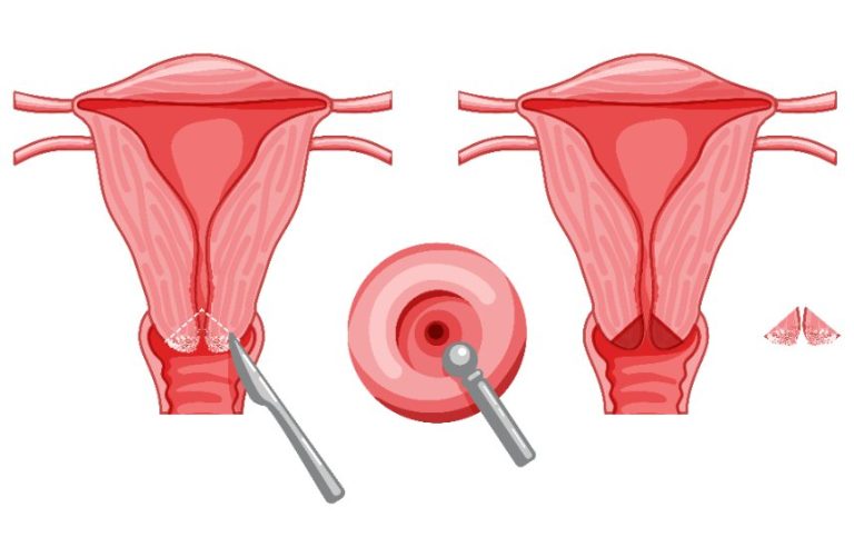 Conisation Cervicale