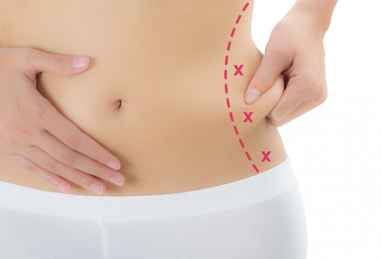 Liposuccion au Laser