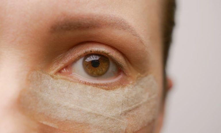 Blépharoplastie inférieure