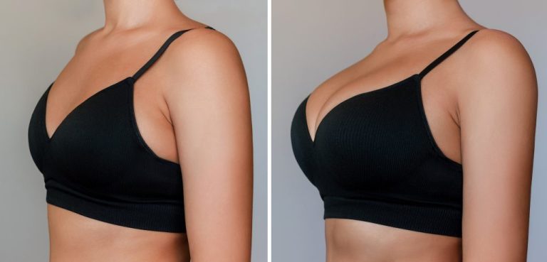 Augmentation mammaire naturelle