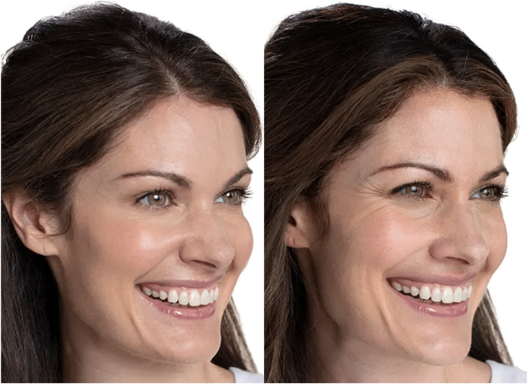 botox yeux amande avant après