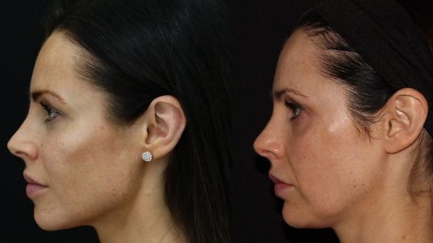 jawline contouring