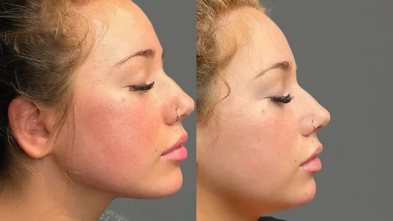 jawline contouring