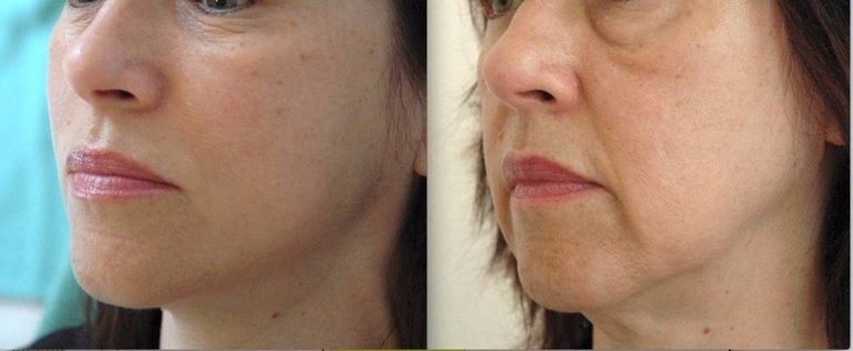 mini-lifting visage avant après