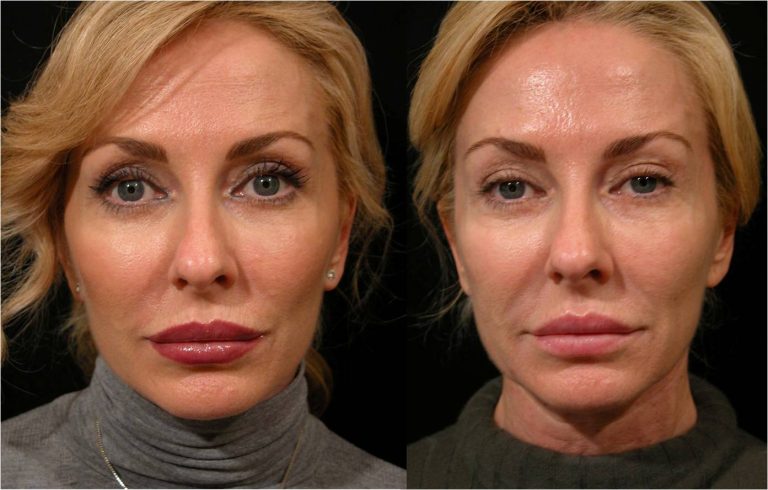 mini-lifting visage avant après