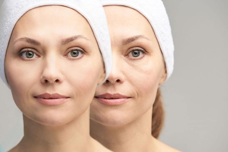 rajeunissement du visage