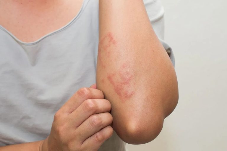 7-signes-intolerance-au-gluten