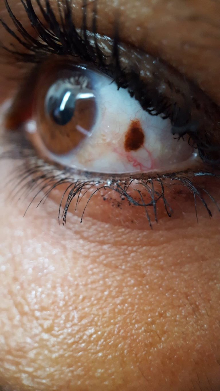 Grain de beauté dans l’œil