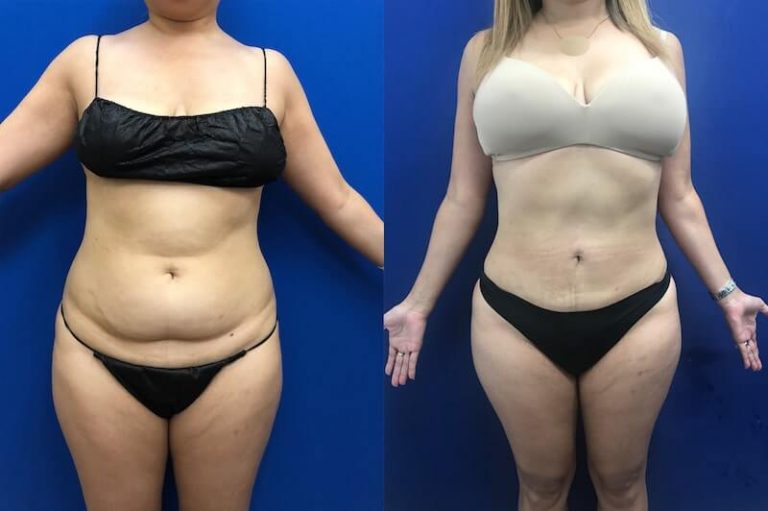Liposuccion - combien de tailles peut-on perdre ?