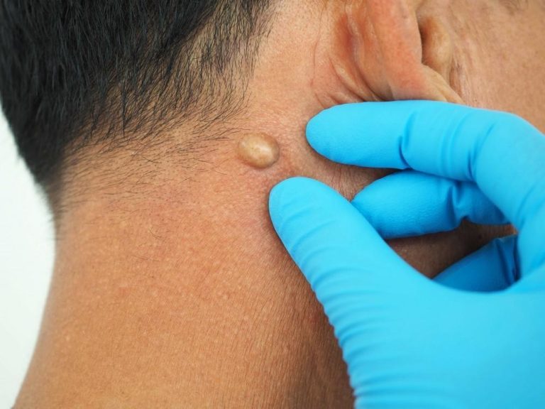 lipome cancéreux symptôme