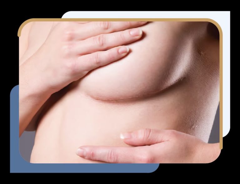 mastectomie pourquoi
