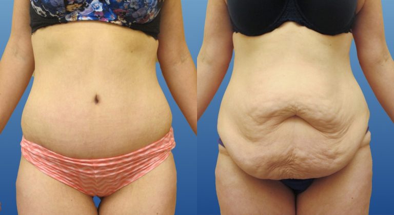 prix abdominoplastie