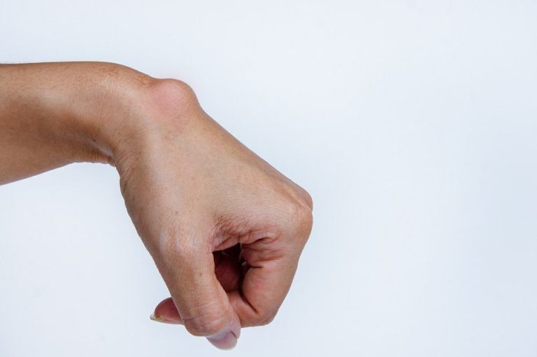 Kyste synovial au poignet