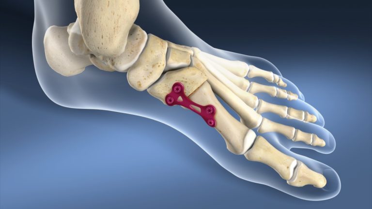 combien-de-temps-souffre-ton-apres-arthrodese