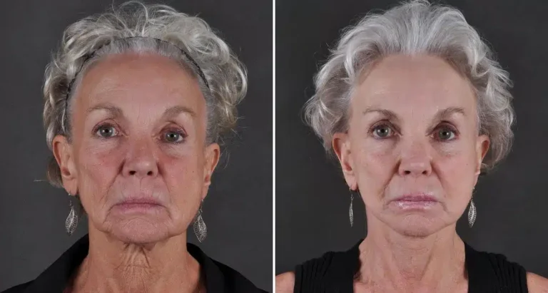 lifting-visage-prix