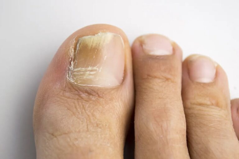 mycose-des-ongles-et-huile-essentielle