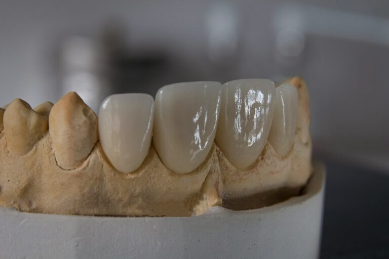 couronne-ceramo-metallique