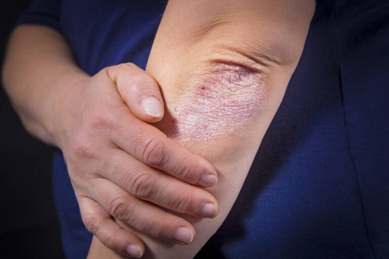 dermatologiques-psoriasis
