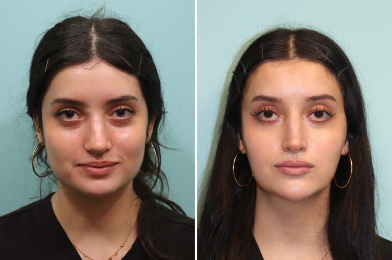 botox-masseter