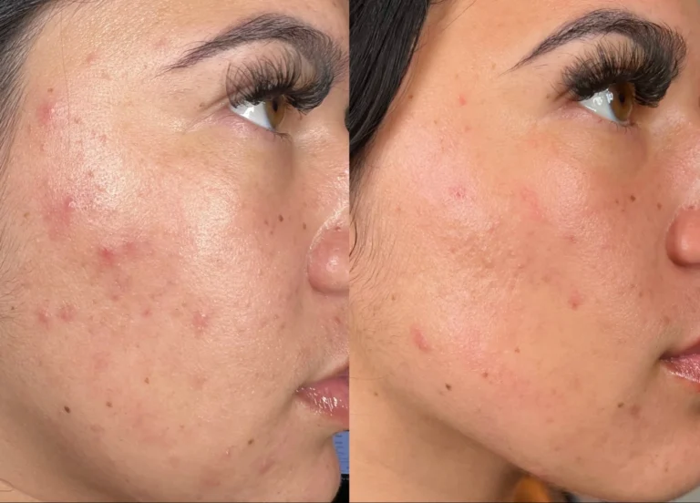 hydrafacial-avant-apres