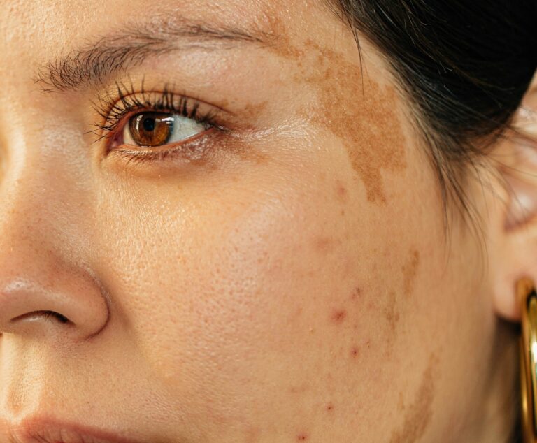 melasma