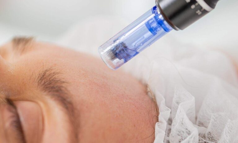 microneedling