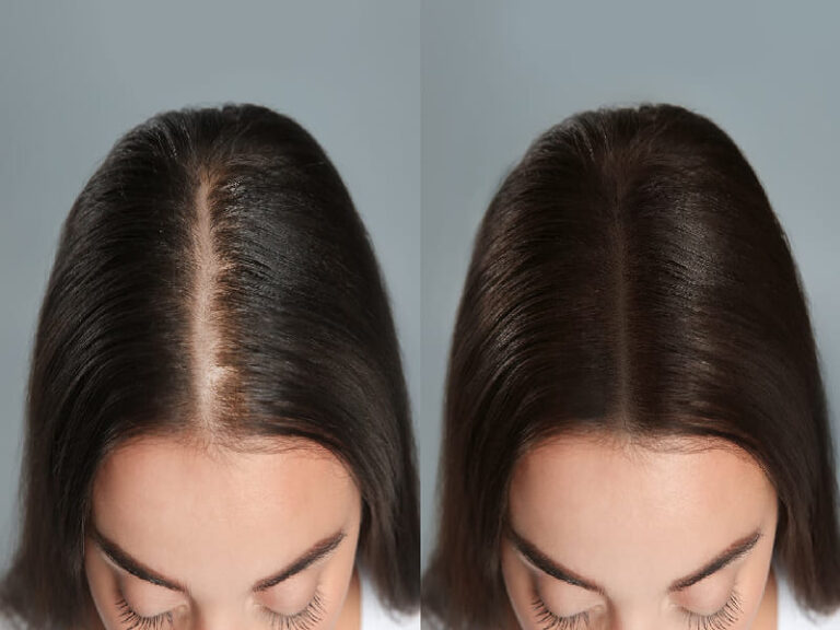 mesotherapie-cheveux-avant-apres