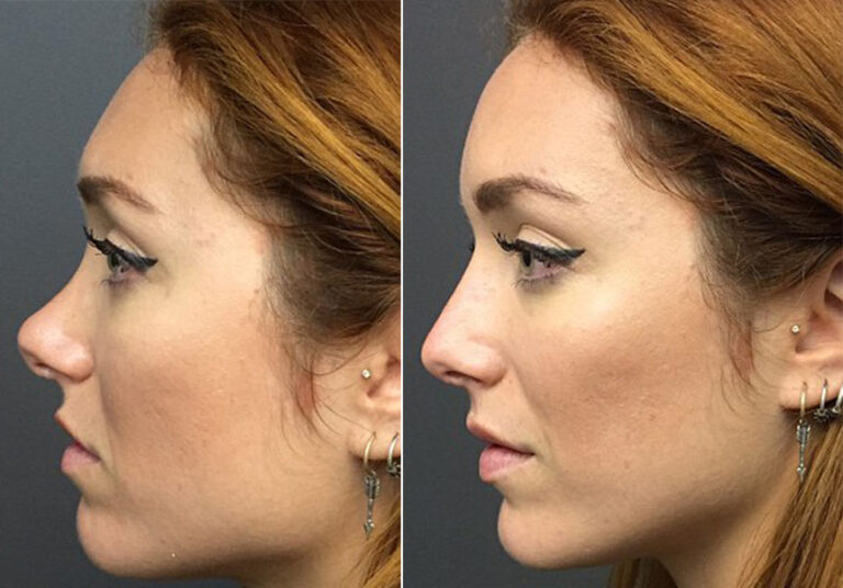 rhinoplastie-sans-chirurgie