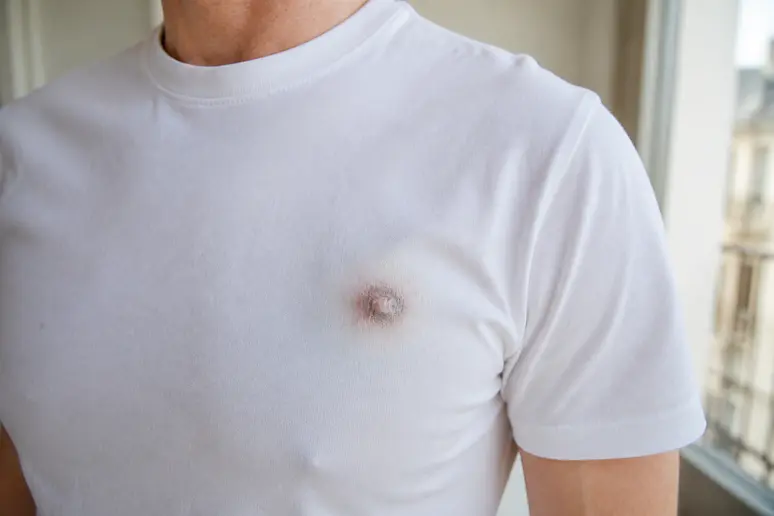 Évolution des cicatrices après une chirurgie de gynécomastie avant après, focus sur la guérison.