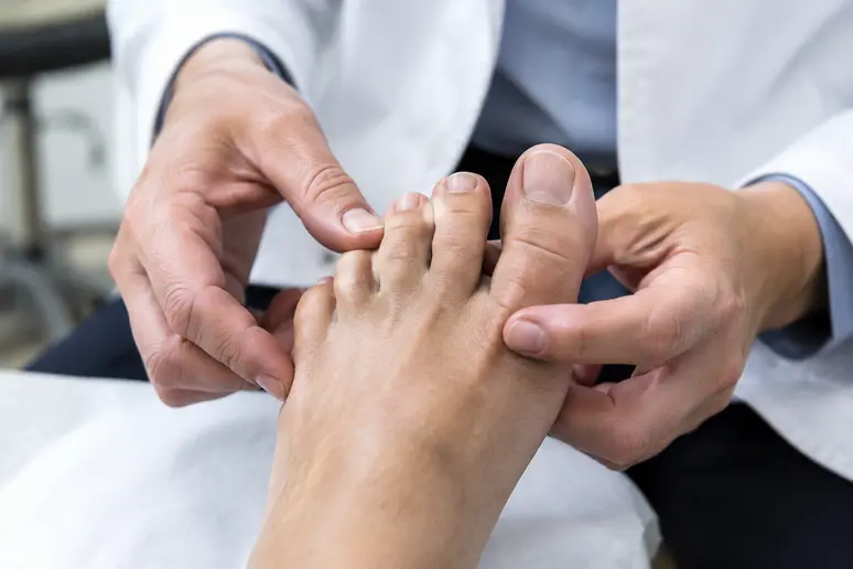 Examen médical de l'alignement des orteils après une chirurgie correctrice des griffes.