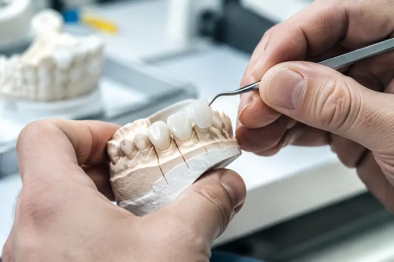 Praticien examinant une facette dentaire en céramique sur un modèle en plâtre