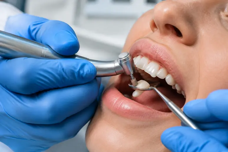 Préparation minutieuse d'une dent naturelle avant la pose d'une facette dentaire