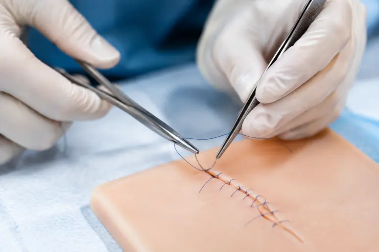 Suture précise réalisée par un chirurgien pour refermer un trou de piercing
